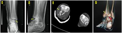 Case Report: Bosworth Fracture-Dislocation managed by Closed Reduction and Conservative Treatment